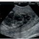 Амниотични ленти - сериозно усложнение на бременността, открити чрез ултразвук