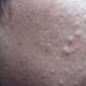 Calcina din piele - boala cauzată de excesul de săruri Ce este calcificarea pielii