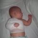 Leziuni la naștere la copii Leziuni la naștere ale organelor interne la nou-născuți